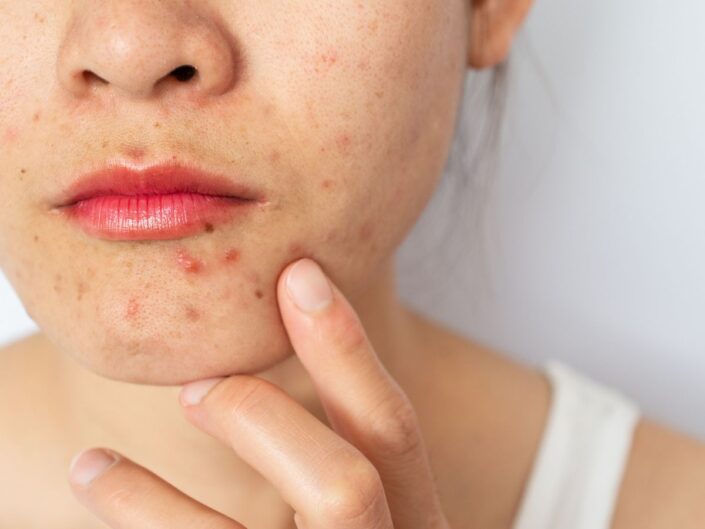 pattanások az állon