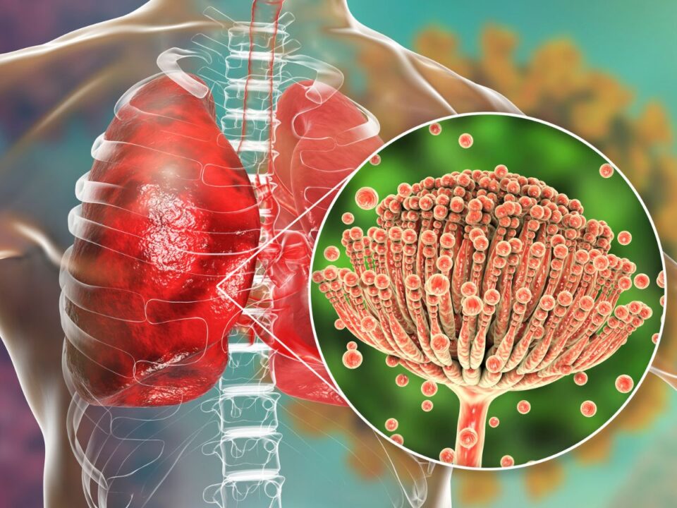 tüdőt támadó gombafertőzés terjed