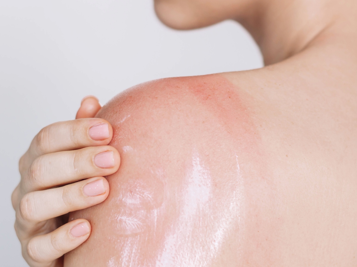 napégés legjobb krém aloe vera
