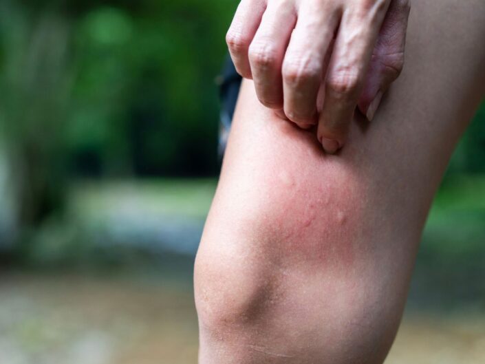 láb szúnyogcsípés viszket piros