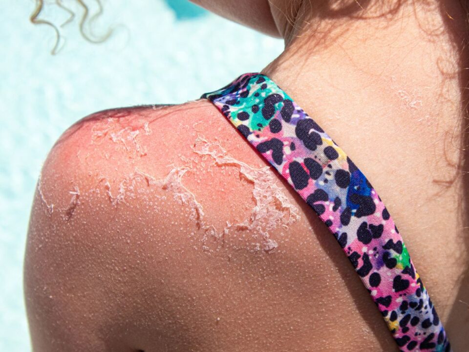 melanoma-borrak-teszt - Nők Lapja melanóma bőrrák teszt