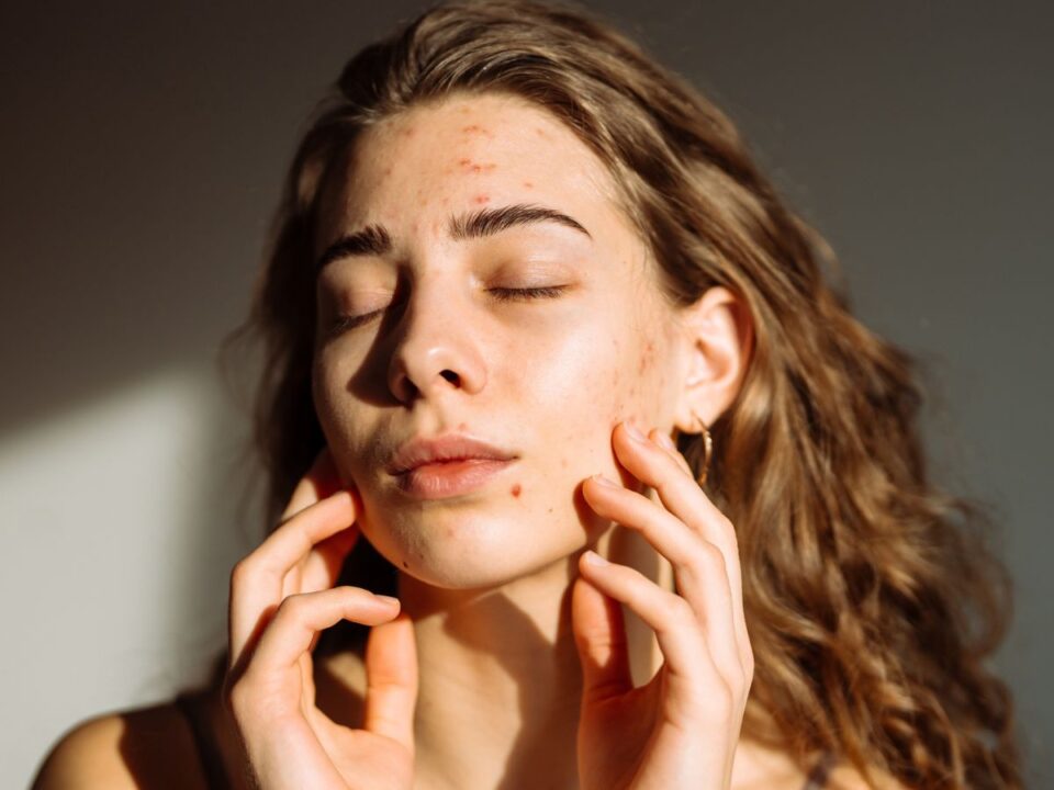nő aknés bőrrel
