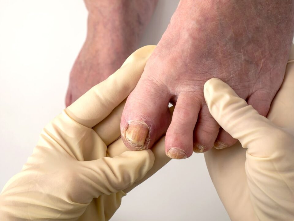 gombás fertőzés foltok körmön