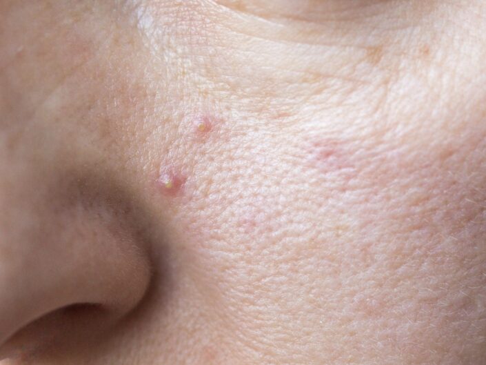 pattanásos bőr