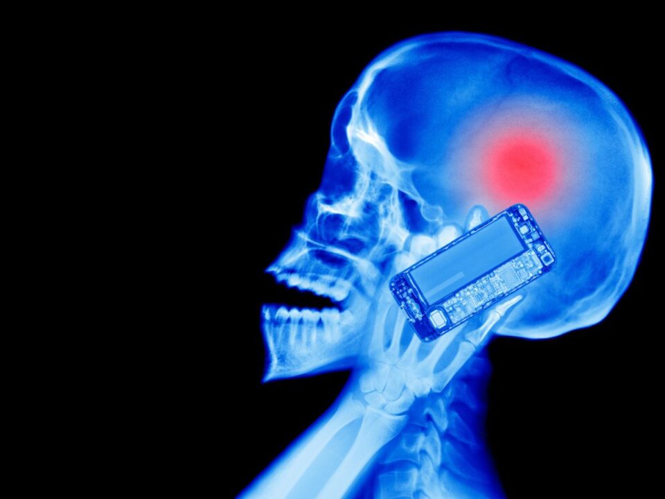 okostelefon-sugarzas-rakkelto-hatasa-tudomany - Nők Lapja röntgen, koponya, mobiltelefon