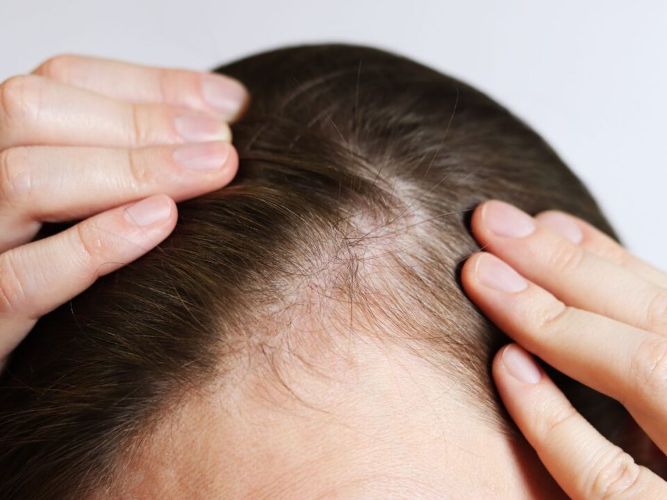 haj-vekonyodas-oregito-hiba - Nők Lapja vékonyodó haj