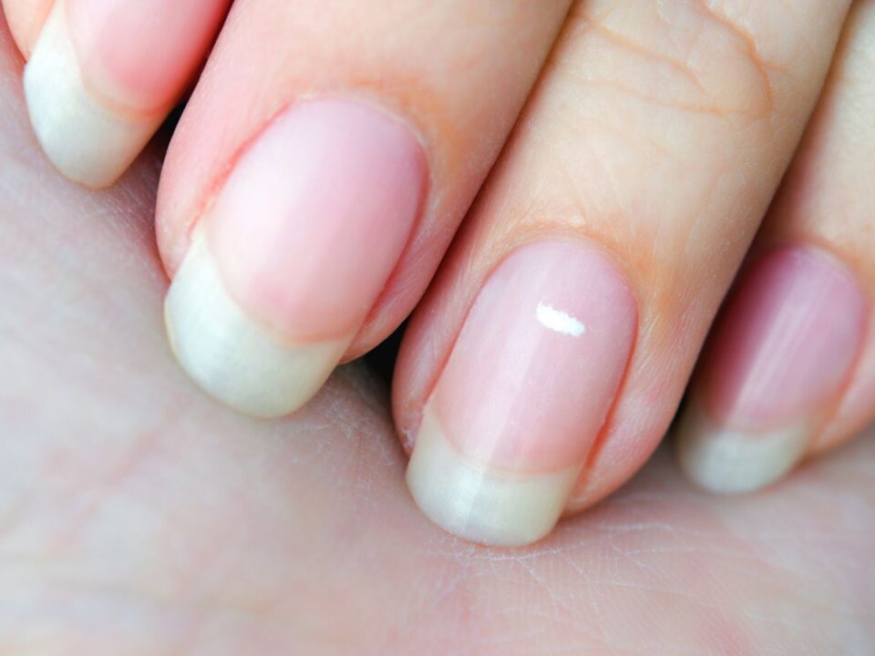 feher-foltok-korom - Nők Lapja fehér folt a körmön