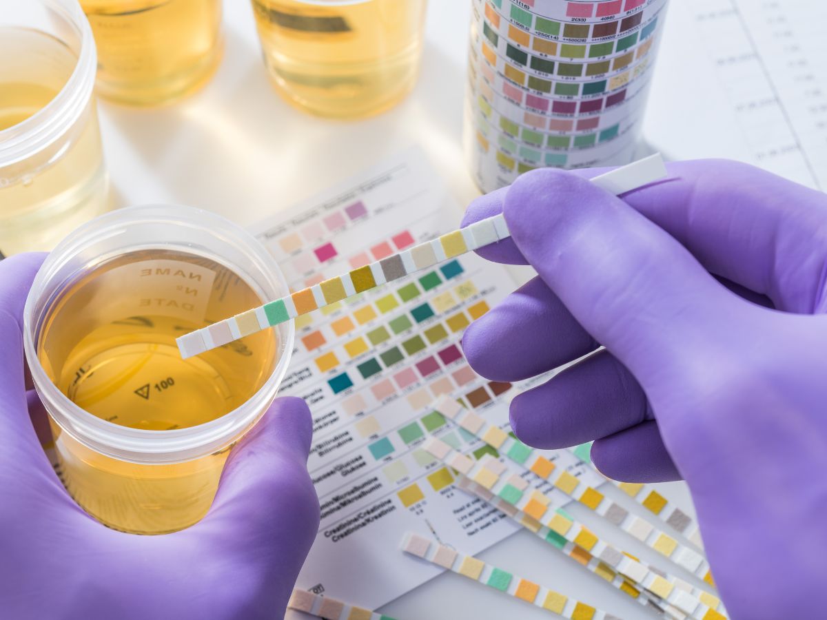 pohárban vizelet laboratóriumi vizsgálat