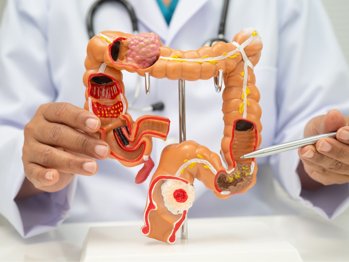 Orvos modellen mutatja a vastagbélrák kialakulását