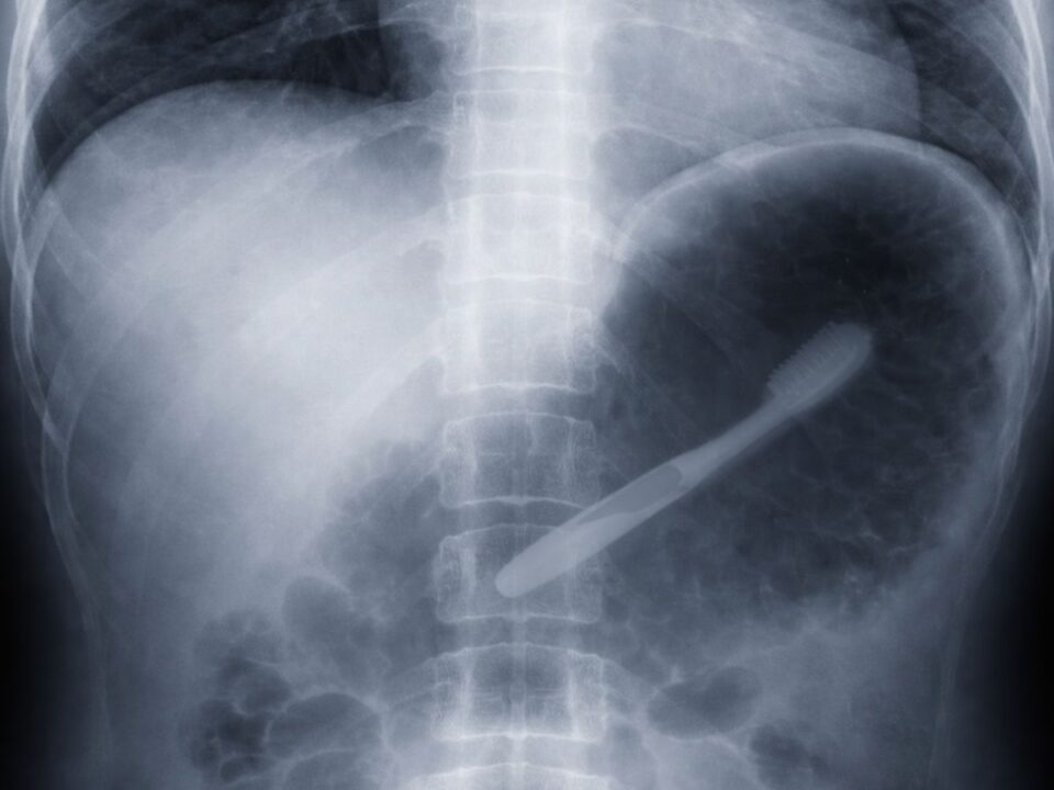 röntgenfelvétel egy lenyelt fogkeféről