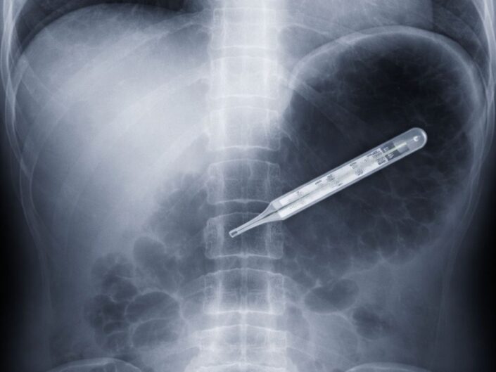röntgenfelvétel egy lenyelt hőmérőről