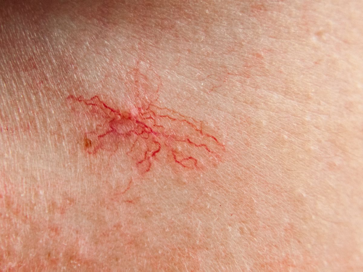 Apró, vörös, pókhálószerű értágulat látható a bőrön, vékony erek sugároznak ki egy központi pontból, ami jellegzetes „póknaevus” megjelenést ad.