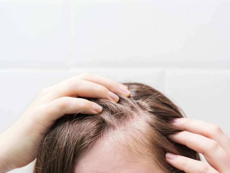 alopecia-klimax - Nők Lapja Nő fejtetején a csíkban kihullot haját mutatja, két kézzel húzza szét a barna haját, fehér csempe a háttérben