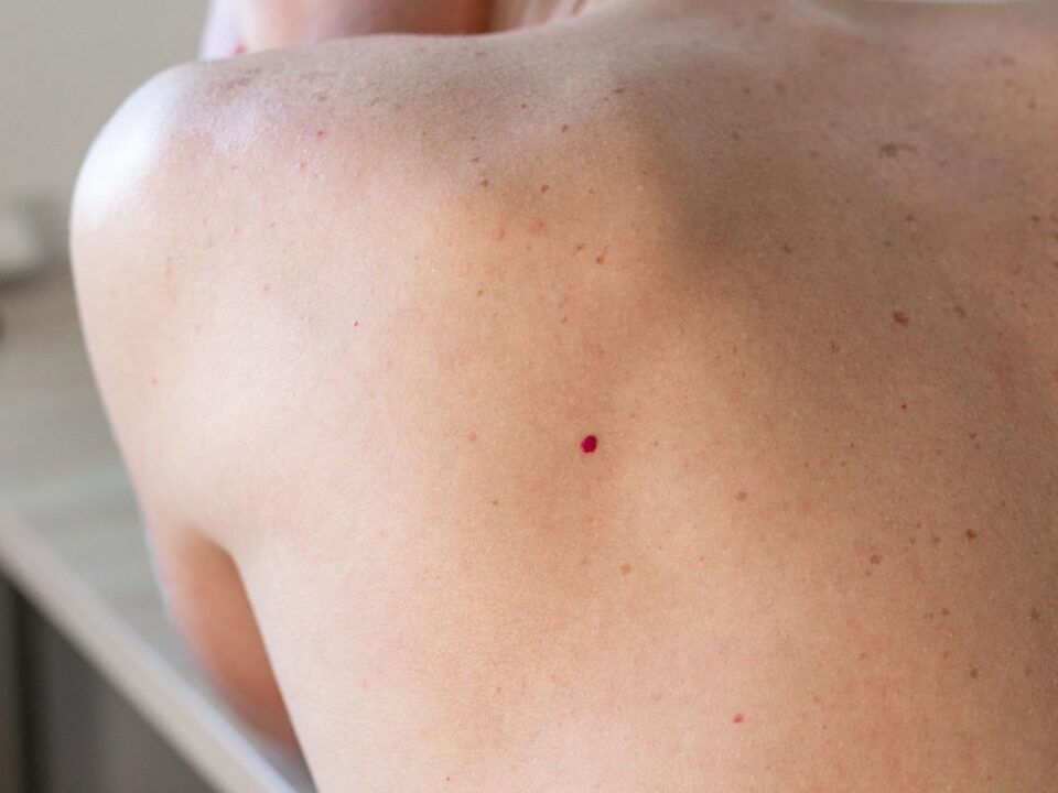 piros pötty a háton angioma rubinfolt
