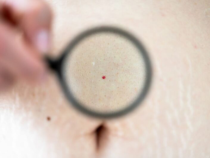 piros pötty a hason angioma