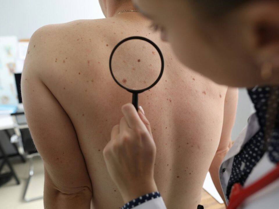 melanoma-borgyogyasz - Nők Lapja Bőrgyógyász nagyítóval anyajegyeket vizsgál női páciens hátán
