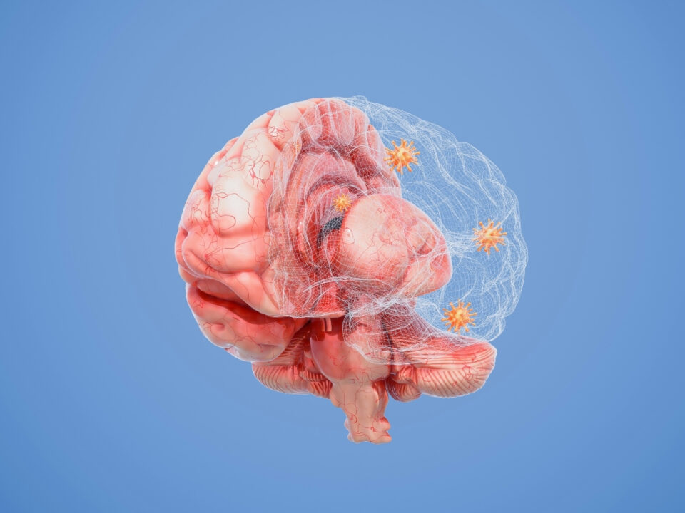 alzheimer-agy - Nők Lapja Kék háttéren agy számítógépes 3 dimenziós ábrázolása, fele rózsaszín, fele hálós plakkokkal, melyek az Alzheimer-kórt jelzik