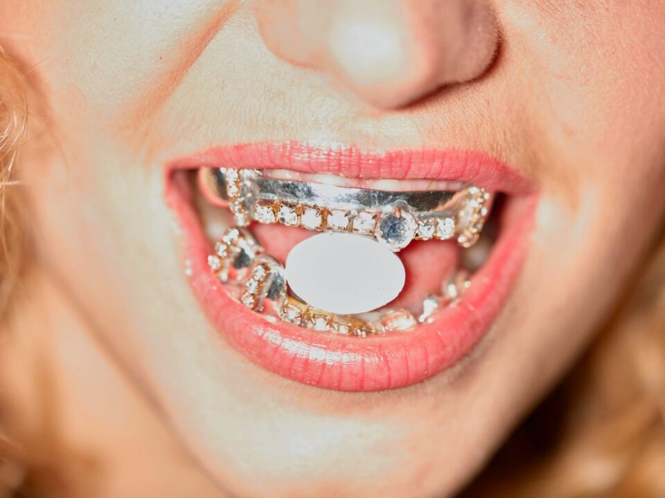 arany grillz